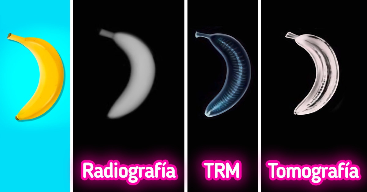 Cuál es la diferencia entre una radiografía, TRM y una tomografía